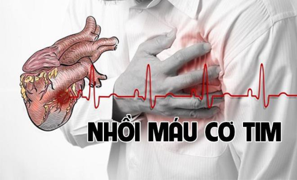 Nhồi máu cơ tim: Nguyên nhân và cách phòng ngừa