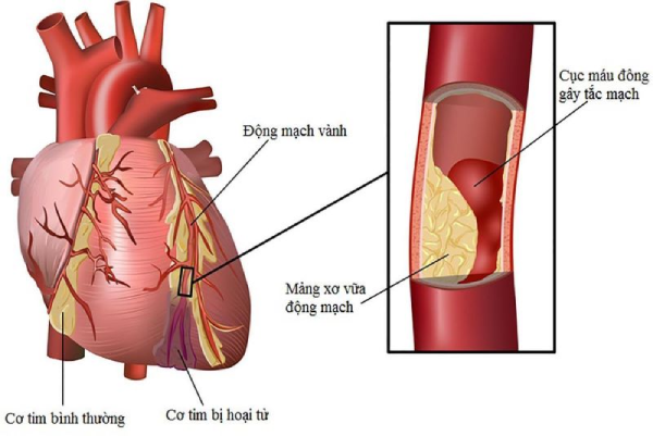 Những nguyên nhân gây nhồi máu cơ tim